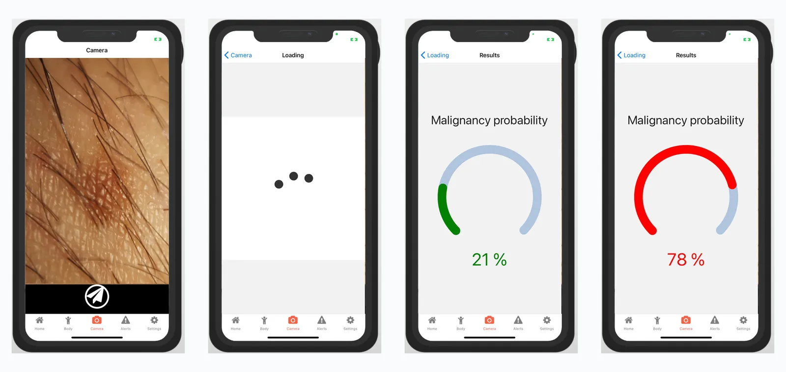 Esito nell'app ALA: ripresa della lesione, elaborazione, probabilità di malignità bassa al 21 per cento e alta al 78 per cento